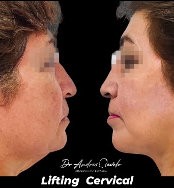 Resultado Lifting Cervical Dr. Revelo Cali